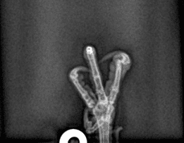 Radiograph of Amelia's foot, showing the dislocated toe.