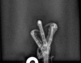 Radiograph of Amelia's foot, showing the dislocated toe.